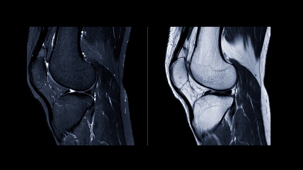 legamenti del ginocchio