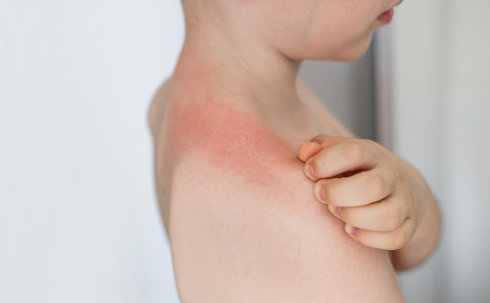 bambino con sfogo da allergia al sole
