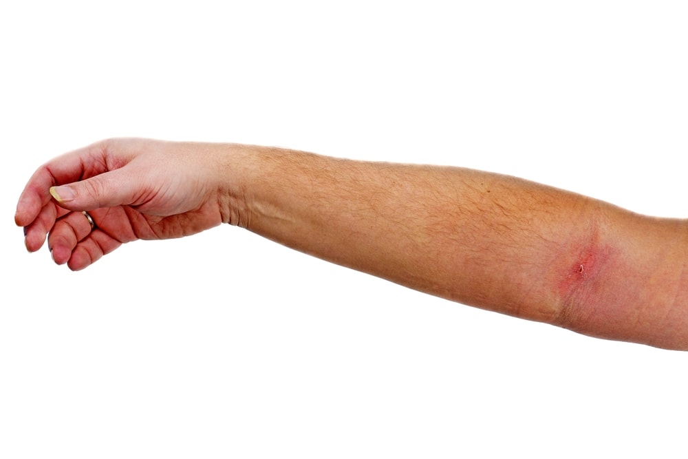 braccio con flebite