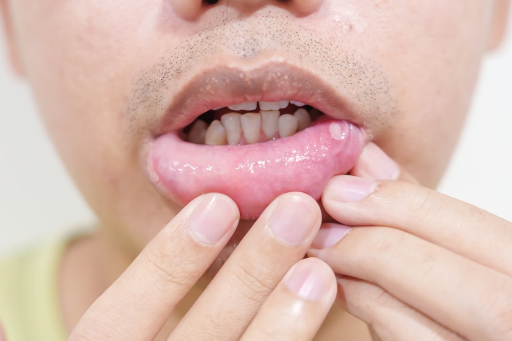 mucocele