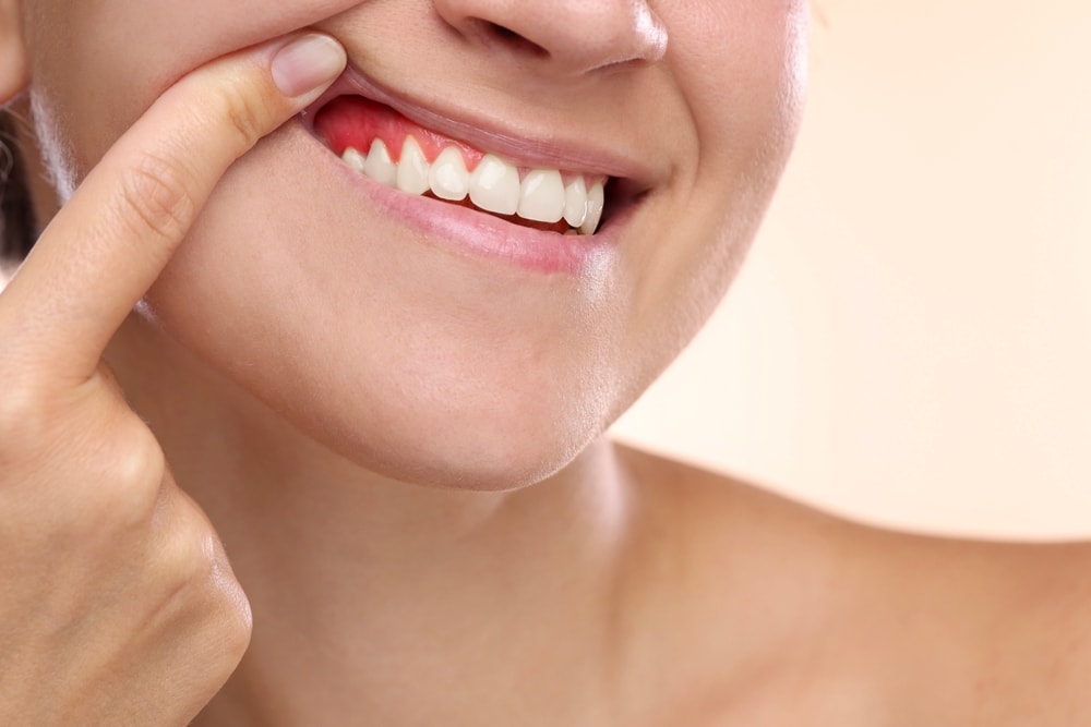 gengive rosse per gengivite