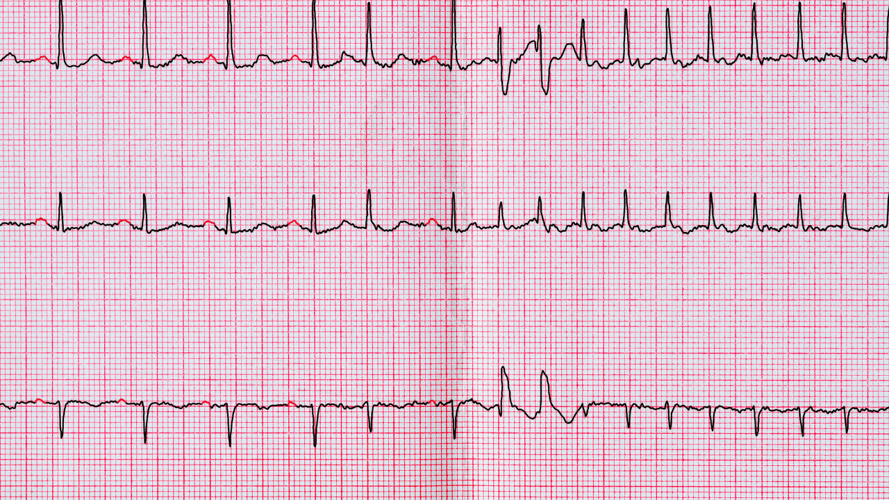 Fibrillazione Atriale Cos Sintomi Cause E Diagnosi