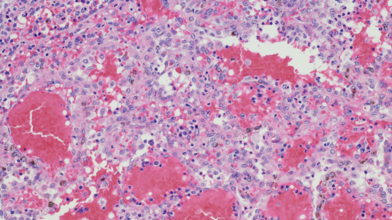 angioma vista microscopio