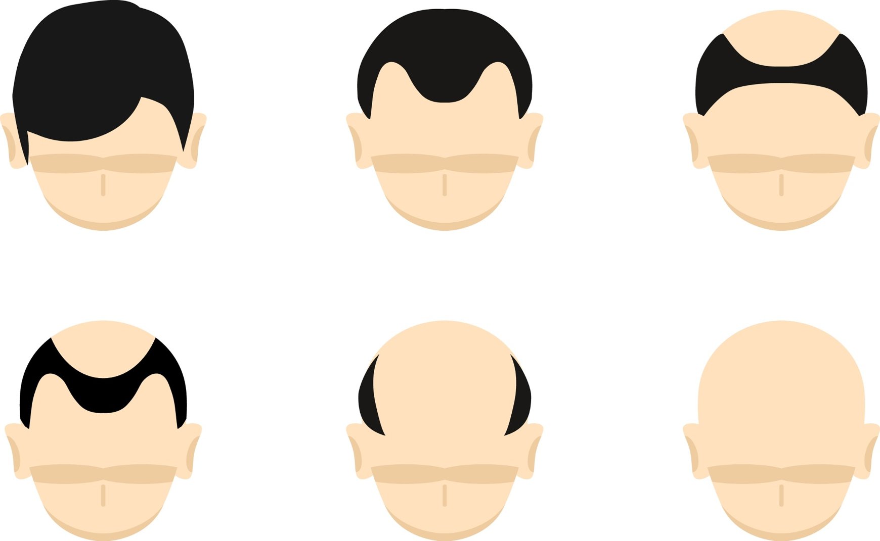 alopecia androgenetica