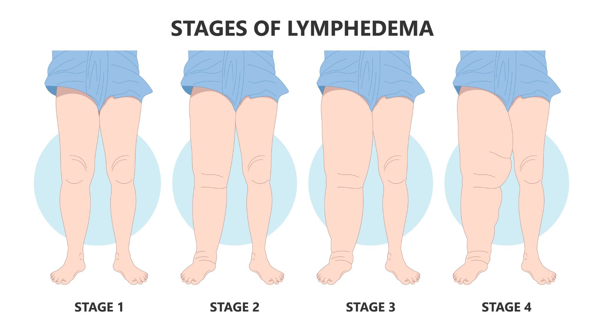stadi del lipedema