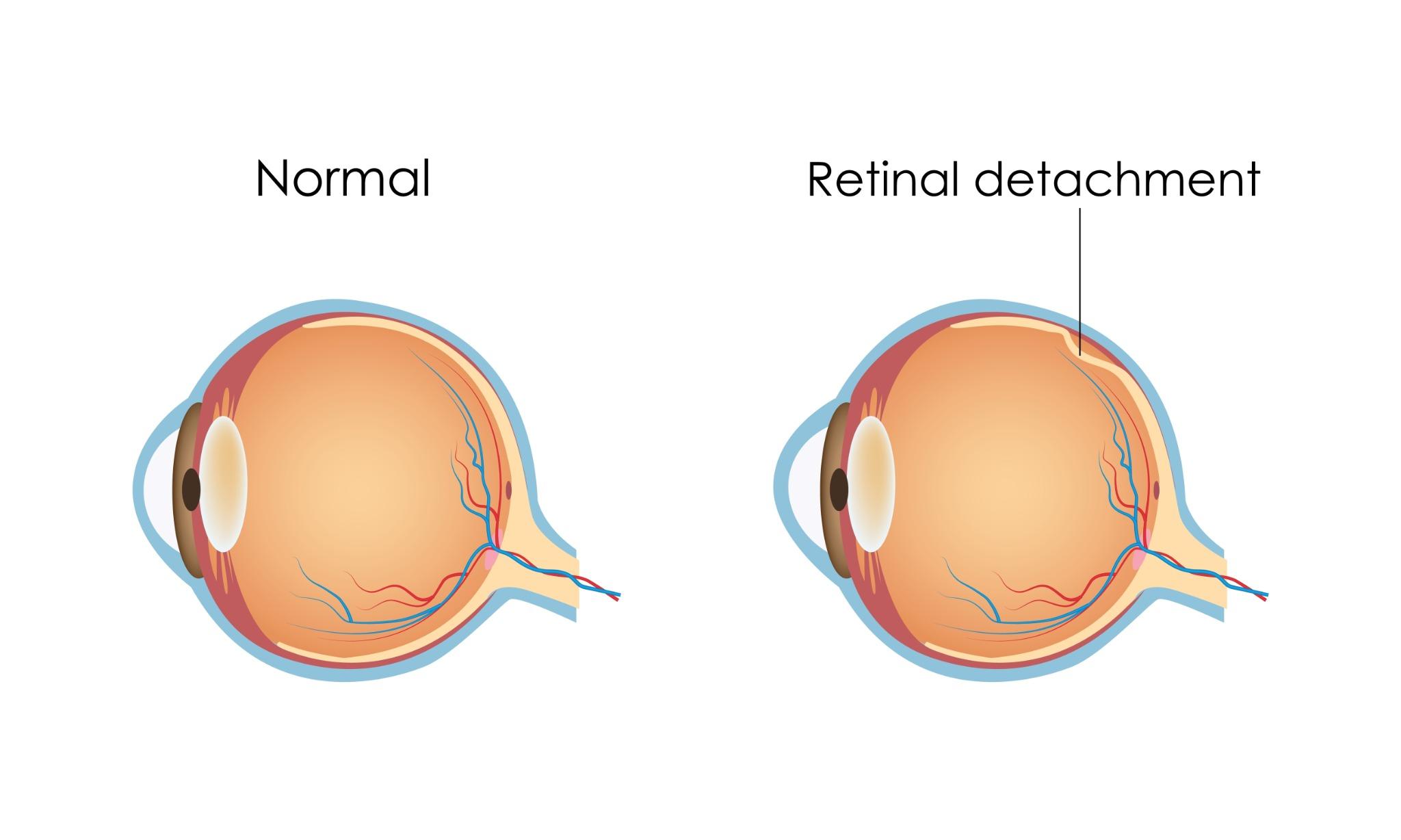 distacco retina